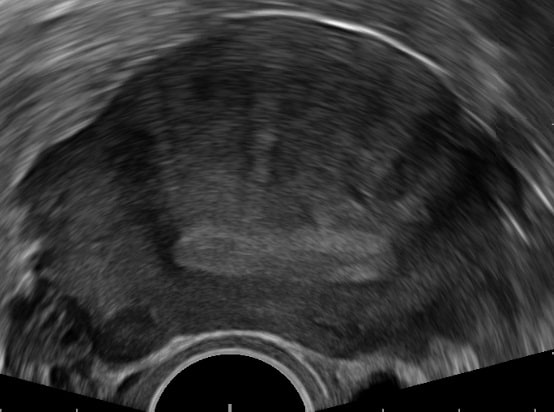 Image of transvaginal ultrasound